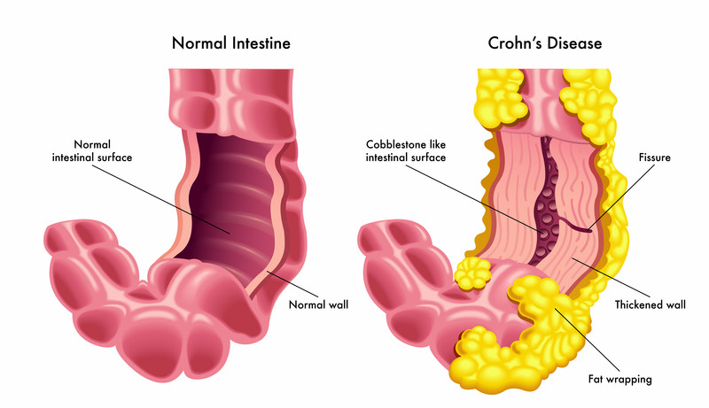 crohn's disease self-care