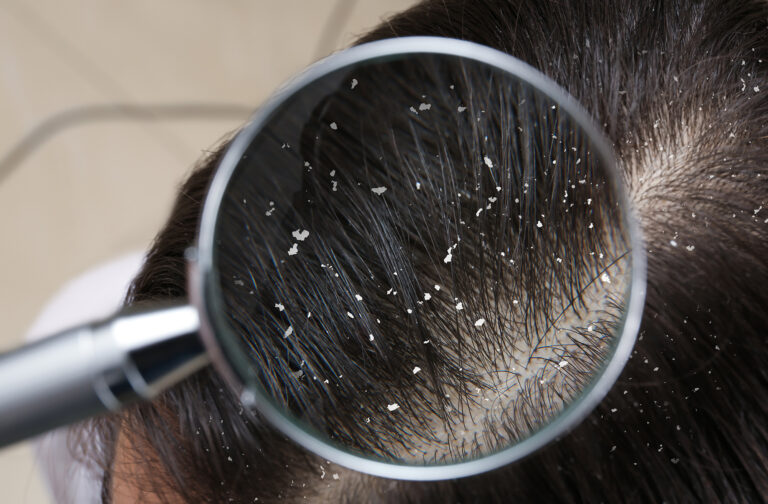 can dandruff cause hair loss