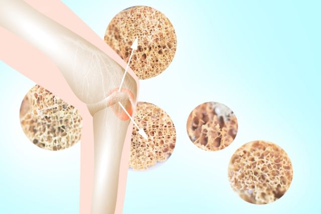 Screening for Osteoporosis ICD 10