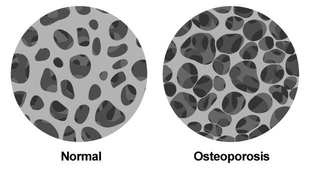 Screening for Osteoporosis ICD 10