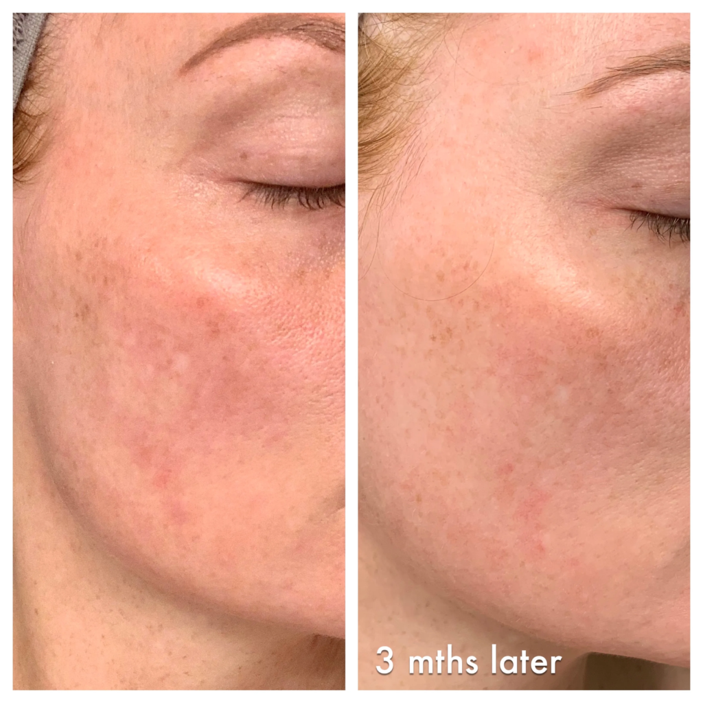 Vitamin C Serum Before and After