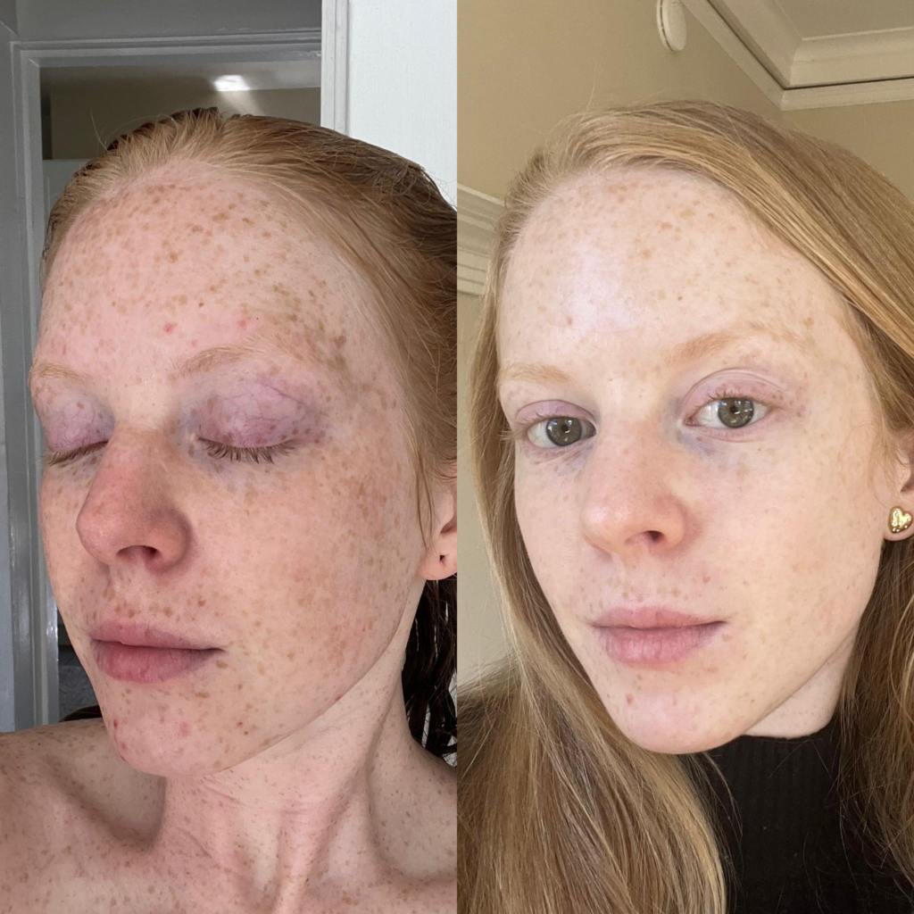 Vitamin C Serum Before and After