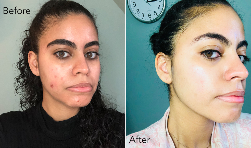 Vitamin C Serum Before and After