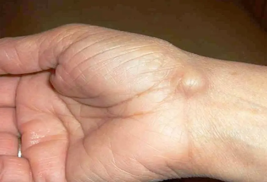 Ganglion Cyst Vitamin Deficiency