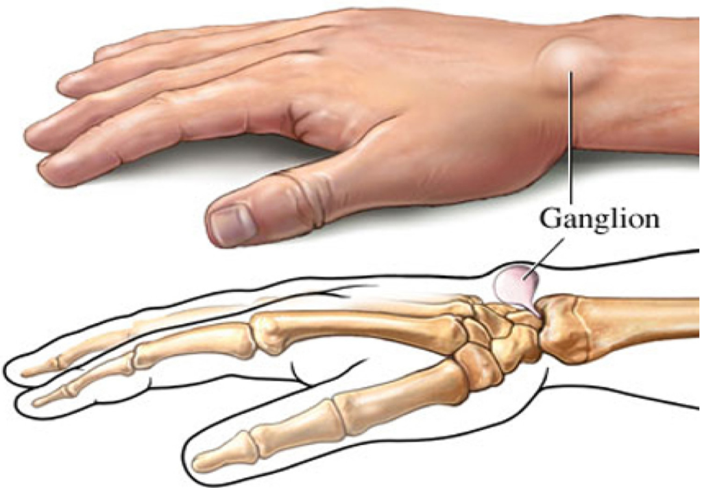 Ganglion Cyst Vitamin Deficiency