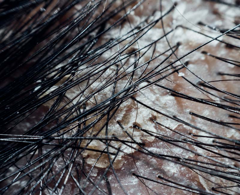 person scratching itchy scalp with dandruff flakes showing common causes of dandruff